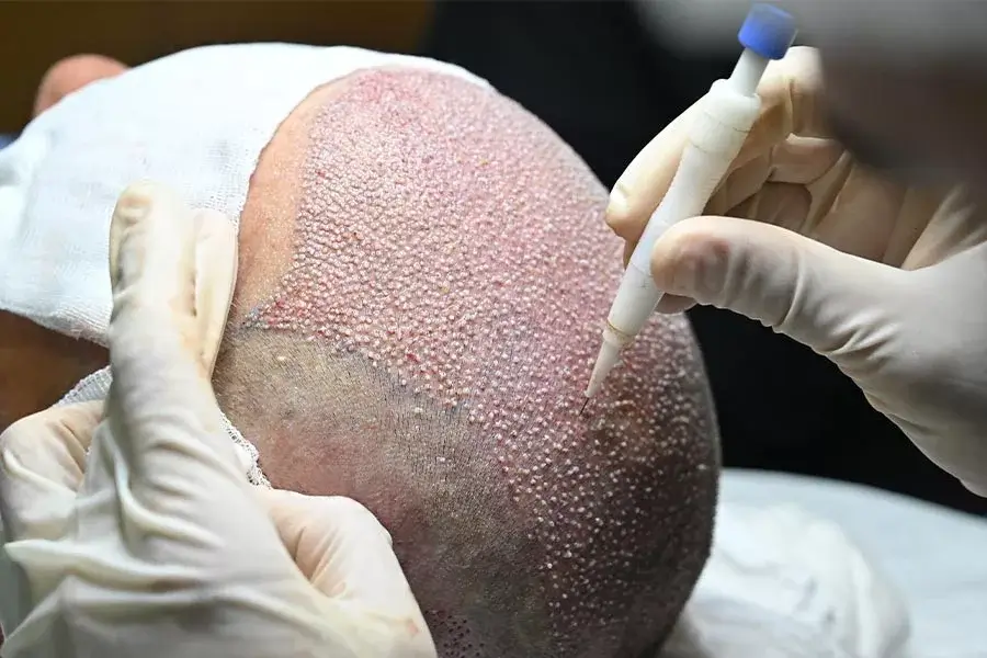 DHI-Haartransplantation