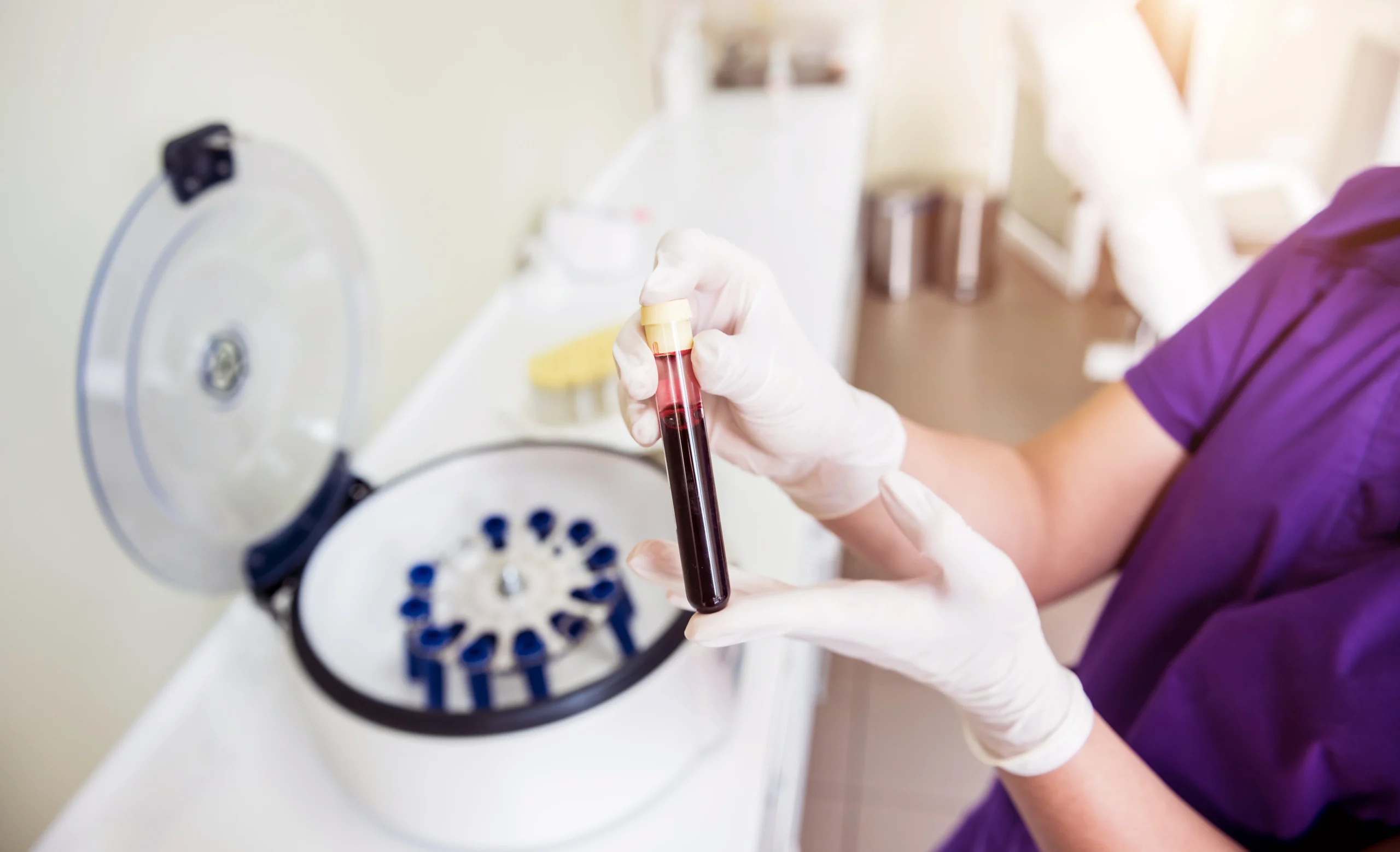 PRP und Haarregeneration
